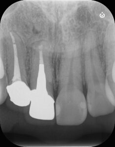 歯根端切除術後