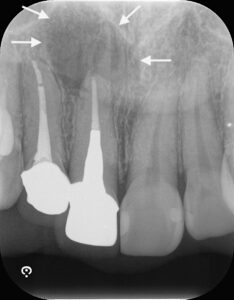 歯根端切除術前